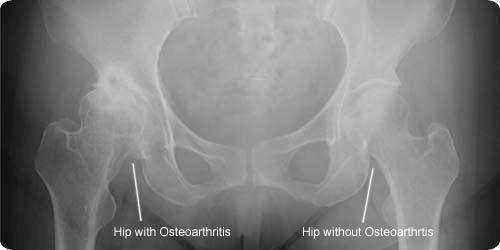 Xray Hip Osteoarthritis