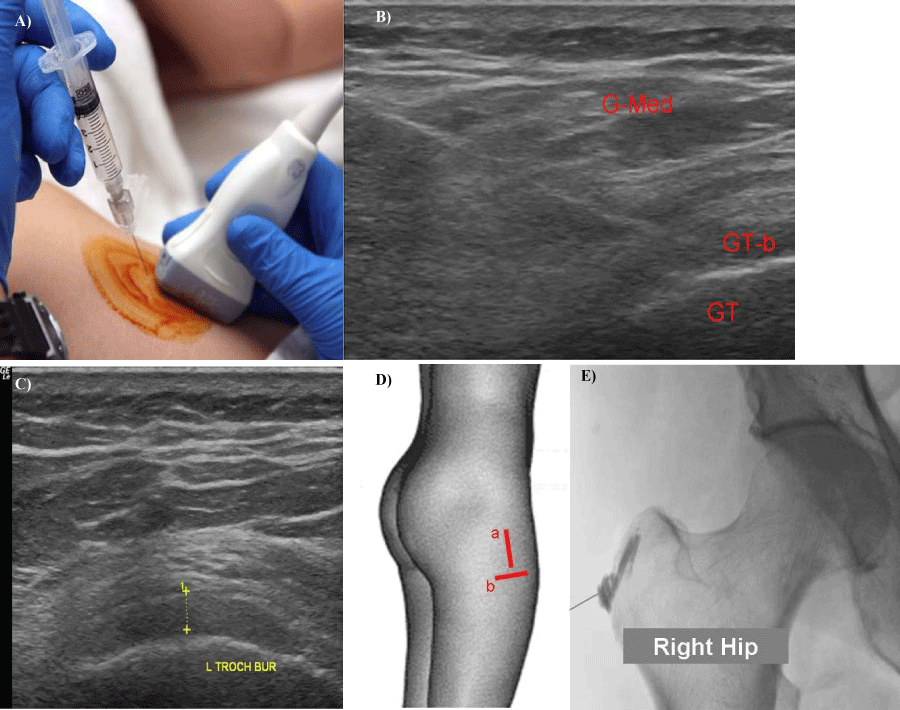 Ultrasound Injection Trochanteric Bursitis