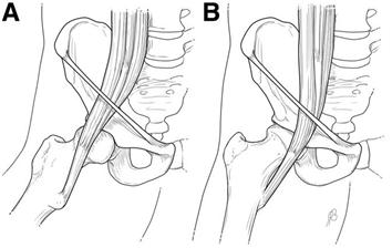 Snapping Hip syndrome