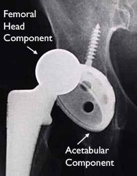 Dislocation Total Hip Replacement