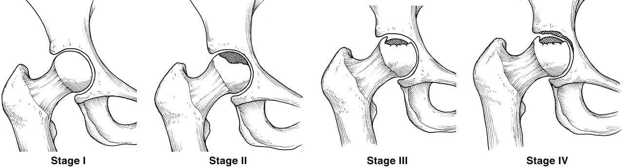 Stages of Avascular Necrosis