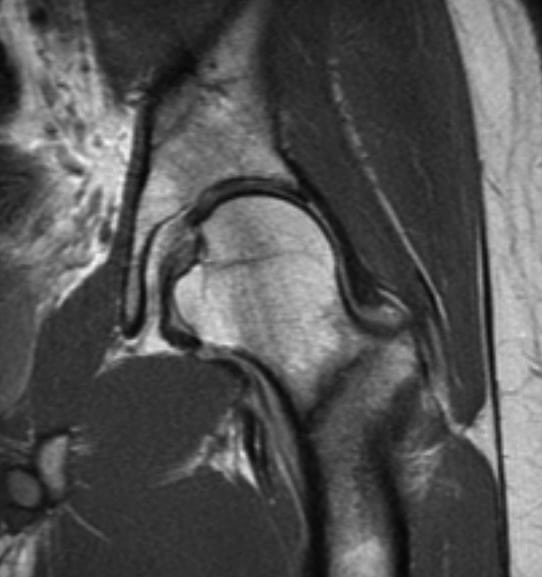 MRI Stress Fracture of the Hip