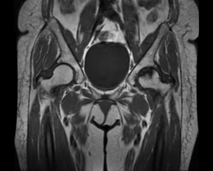 MRI scan Avascular Necrosis