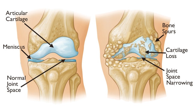 arthritis knee
