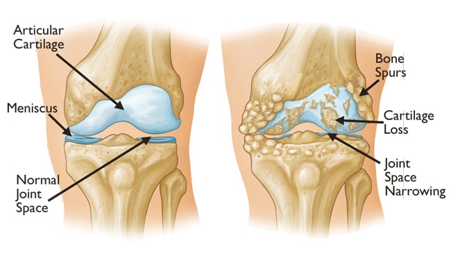 arthrose du genou